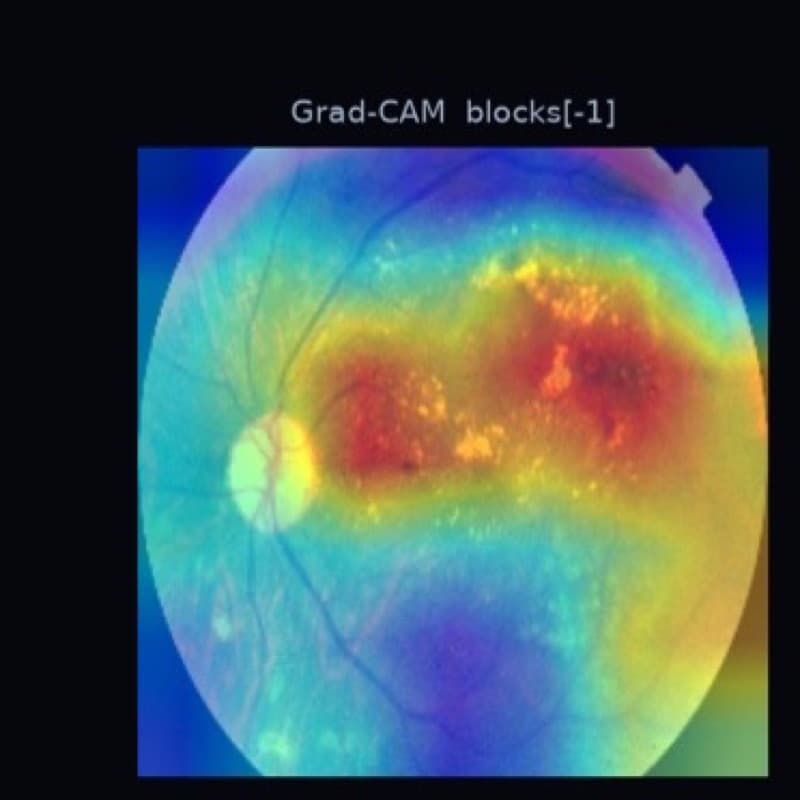 Grad-CAM heatmap over a retinal photograph, showing the regions the model weighted most heavily